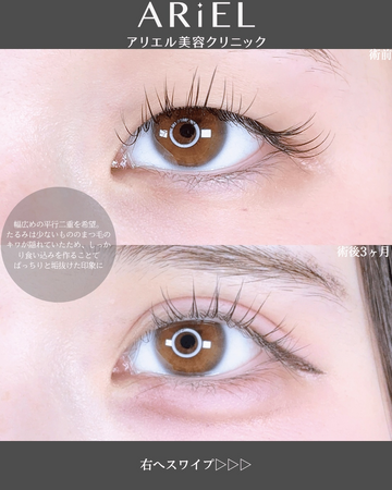 アリエル美容クリニック 郡山院の目・二重整形の症例写真