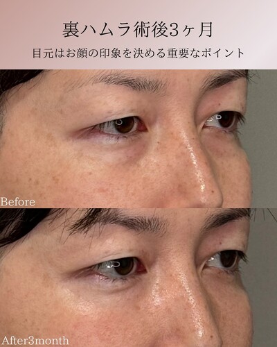 裏ハムラの症例写真