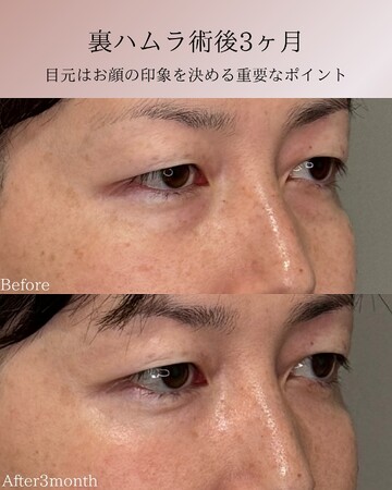 KNOT CLINIC AOYAMAの目元・クマ・眉下・涙袋整形の症例写真