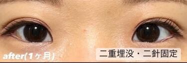 二重埋没法　二針固定法の症例写真[アフター]