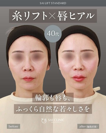 SAI CLINIC （サイクリニック）のリフトアップの症例写真