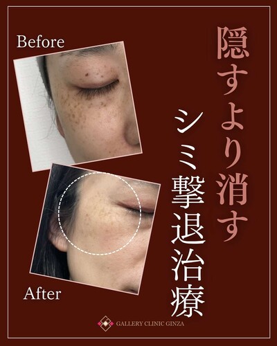 隠すより消す✨️シミ撃退治療の症例写真