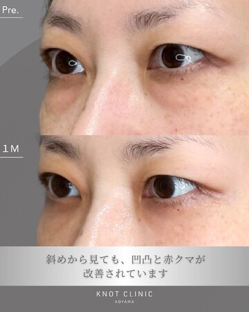 KNOT CLINIC AOYAMAの目元・クマ・眉下・涙袋整形の症例写真