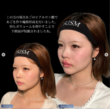 PRISM Beauty Clinicのしわ・たるみ整形(注入、糸、フェイスリフト)の症例写真