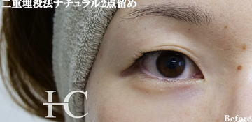 静岡美容外科橋本クリニックの二重の症例写真[ビフォー]