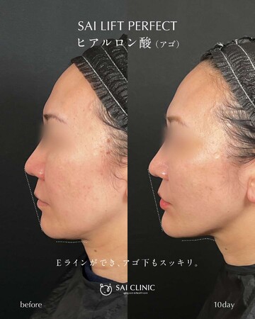 SAI CLINIC （サイクリニック）のリフトアップの症例写真