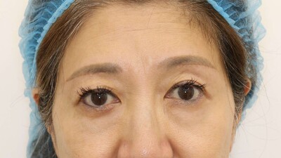 眉下切開の症例写真[アフター]