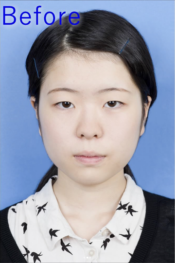 新宿中央クリニックの目・二重整形の症例写真[ビフォー]