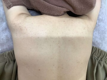 フェミークリニックのニキビ・ニキビ跡の治療の症例写真[ビフォー]