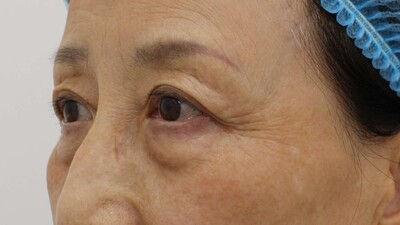 ハムラ法の症例写真[ビフォー]