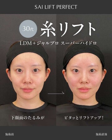SAI CLINIC （サイクリニック）のリフトアップの症例写真