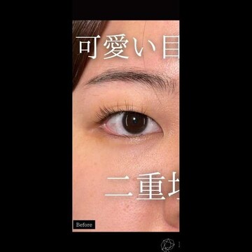 PRISM Beauty Clinicの二重の症例写真[ビフォー]