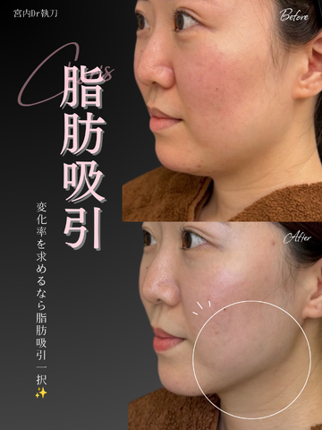 CHARIS BEAUTY CLINICの脂肪吸引の症例写真