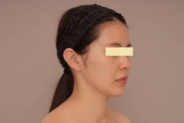Mods Clinic (モッズクリニック)の脂肪吸引の症例写真[ビフォー]