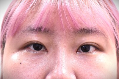 20代　女性　頬、目頭切開　W法　2㎜　当院モニターの症例写真