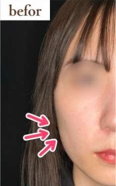 ルラ（LULA）美容クリニックのヒアルロン酸の症例写真[ビフォー]