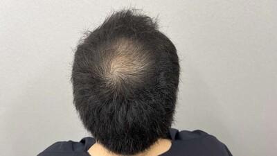 自毛植毛1000グラフト｜30代｜3回の症例写真[アフター]