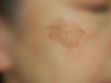 船橋ゆーかりクリニックのシミ取り・肝斑・毛穴治療の症例写真[ビフォー]