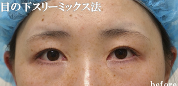 静岡美容外科橋本クリニックの目元・クマ・眉下・涙袋整形の症例写真[ビフォー]