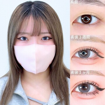 アリエル美容クリニック 大宮院の二重の症例写真