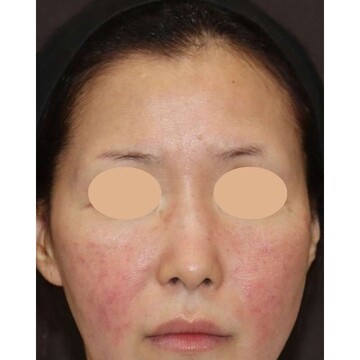 聖心美容クリニックの鼻の症例写真[ビフォー]