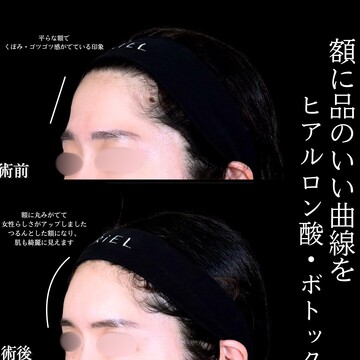 アリエル美容クリニック 大宮院の輪郭・顎・エラ・額・小顔整形の症例写真