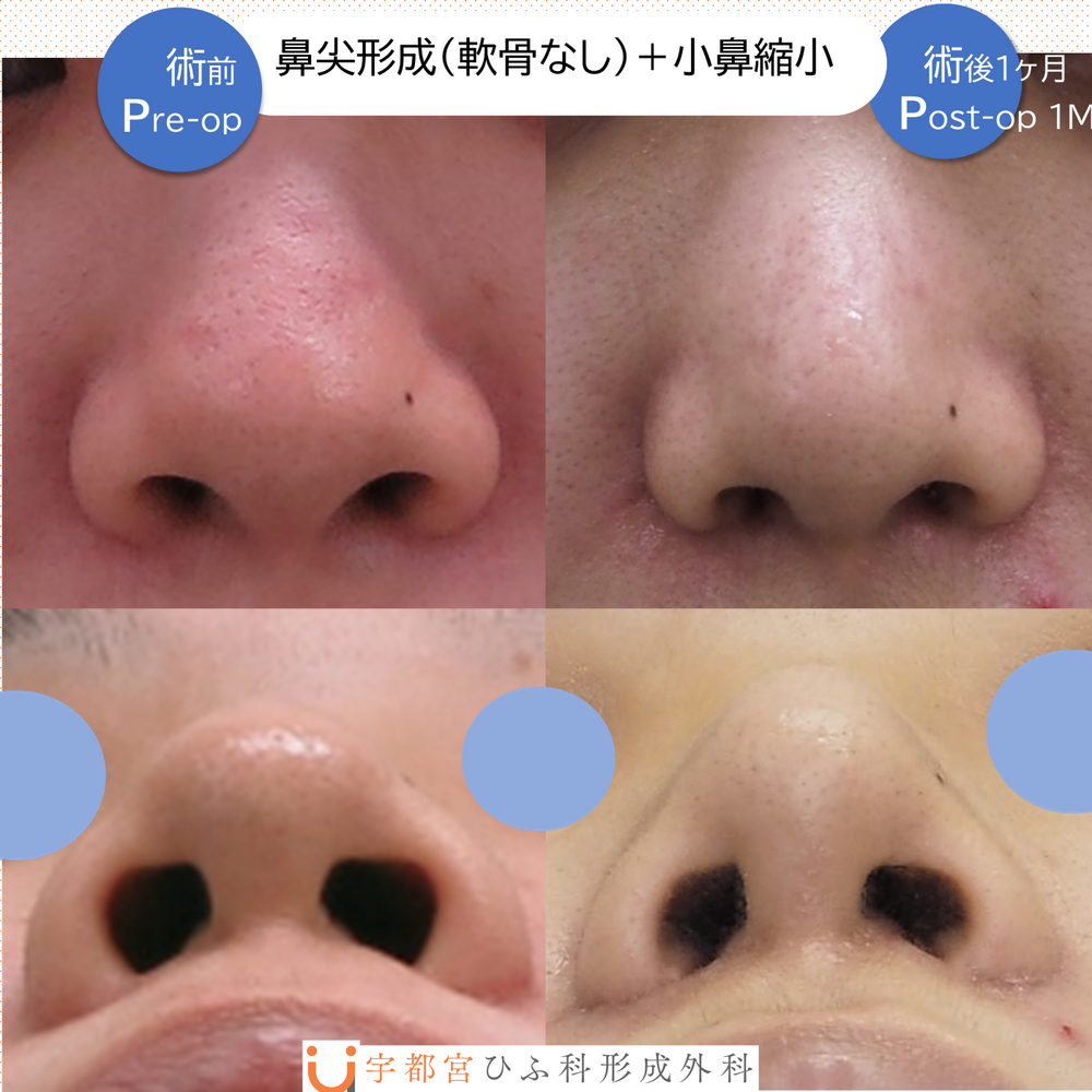 鼻尖形成(軟骨移植なし）、小鼻縮小 (鼻の整形の症例写真・画像