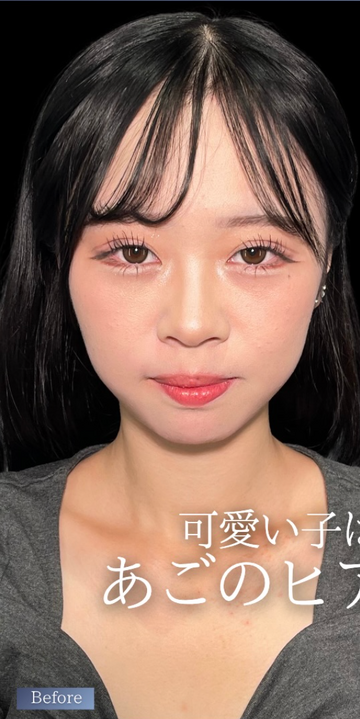 PRISM Beauty Clinicの輪郭・顎・エラ・額・小顔整形の症例写真[ビフォー]