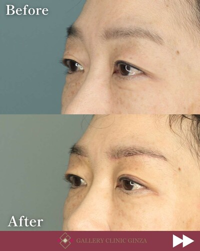 瞼の重みを軽減「眉下切開」の症例写真
