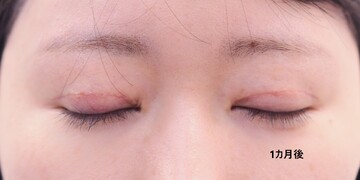 医療法人秀晄会 心斎橋コムロ美容外科クリニックの症例写真[アフター]