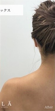 肩ボトックスの症例写真[アフター]