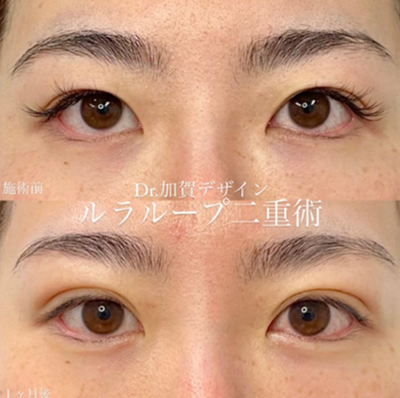 1dayルラループ二重術の症例写真