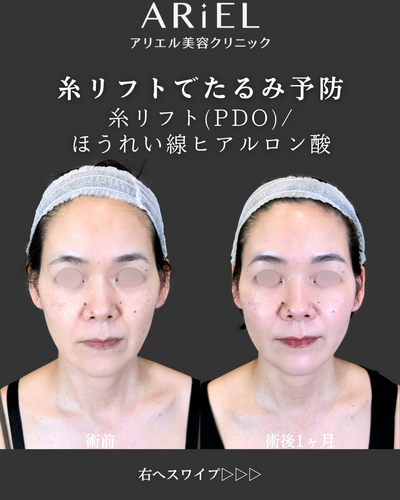 糸リフト/ほうれい線ヒアルロン酸の症例写真