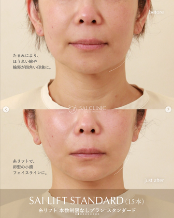 SAI CLINIC （サイクリニック）のリフトアップの症例写真