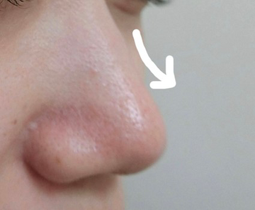 やさしい美容皮膚科・皮フ科 東京浅草院／シミレーザークリニックのその他の美容皮膚科治療の症例写真[ビフォー]