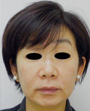 ヒアルロン酸注入によるリフトアップの症例写真[アフター]