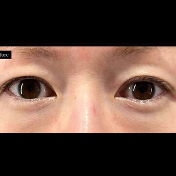 PRISM Beauty Clinicの目元の症例写真[ビフォー]
