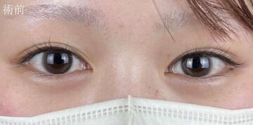 AI Beauty Clinicの二重の症例写真[ビフォー]