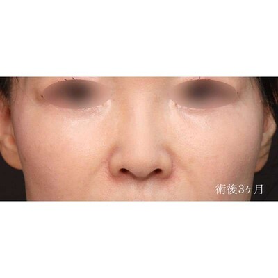 土手を温存した小鼻縮小（内外側法）（術後3ヶ月）の症例写真[アフター]