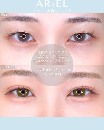 アリエル美容クリニック 横浜院の目・二重整形の症例写真