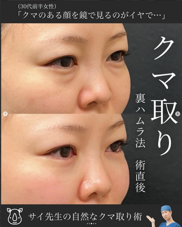 SAI CLINIC （サイクリニック）の目元・クマ・眉下・涙袋整形の症例写真