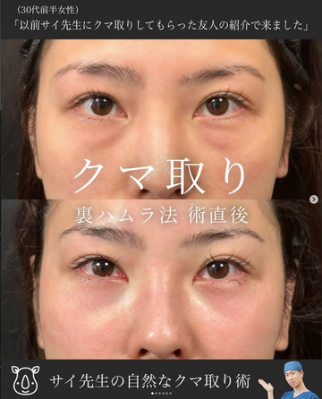 SAI CLINIC （サイクリニック）の目元・クマ・眉下・涙袋整形の症例写真