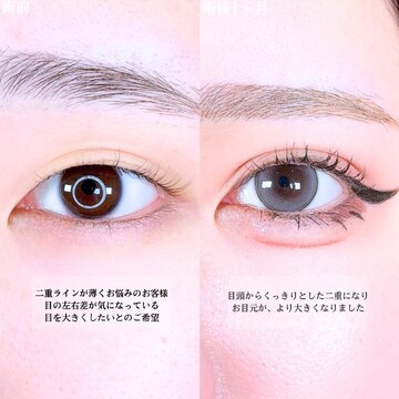 アリエル美容クリニック 大宮院の二重の症例写真