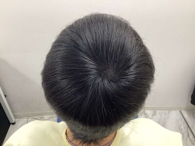 ヘアアートメイク｜20代｜2回の症例写真[アフター]