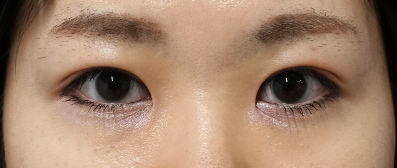 もとびアイプラチナム 【3ヶ月後 】 (二重埋没法の症例写真・画像) - もとび美容外科クリニック 新宿院 (Cs29157)《美容医療の口コミ広場》