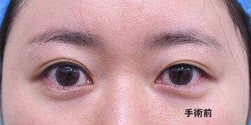 医療法人秀晄会 心斎橋コムロ美容外科クリニックの目・二重整形の症例写真[ビフォー]