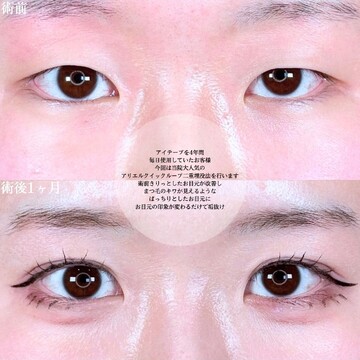 アリエル美容クリニック 大宮院の二重の症例写真