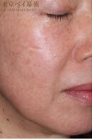 目下のたるみ ほうれい線 マリオネットライン 50代女性 その他 顔のしわ たるみ ほうれい線の整形の症例写真 画像 肌と歯のクリニック 東京ベイ幕張 Cs 美容医療の口コミ広場