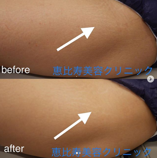 ふくらはぎの肉割れ線治療 肉割れ 妊娠線の治療の症例写真 画像 恵比寿美容クリニック Cs 美容医療の口コミ広場
