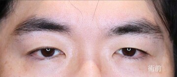聖心美容クリニックの二重の症例写真[ビフォー]